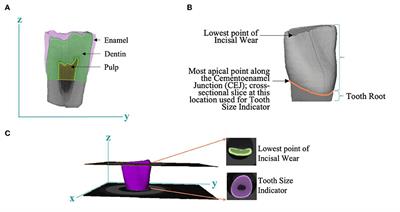 Association Between Measures Derived From Children's Primary Exfoliated Teeth and Psychopathology Symptoms: Results From a Community-Based Study